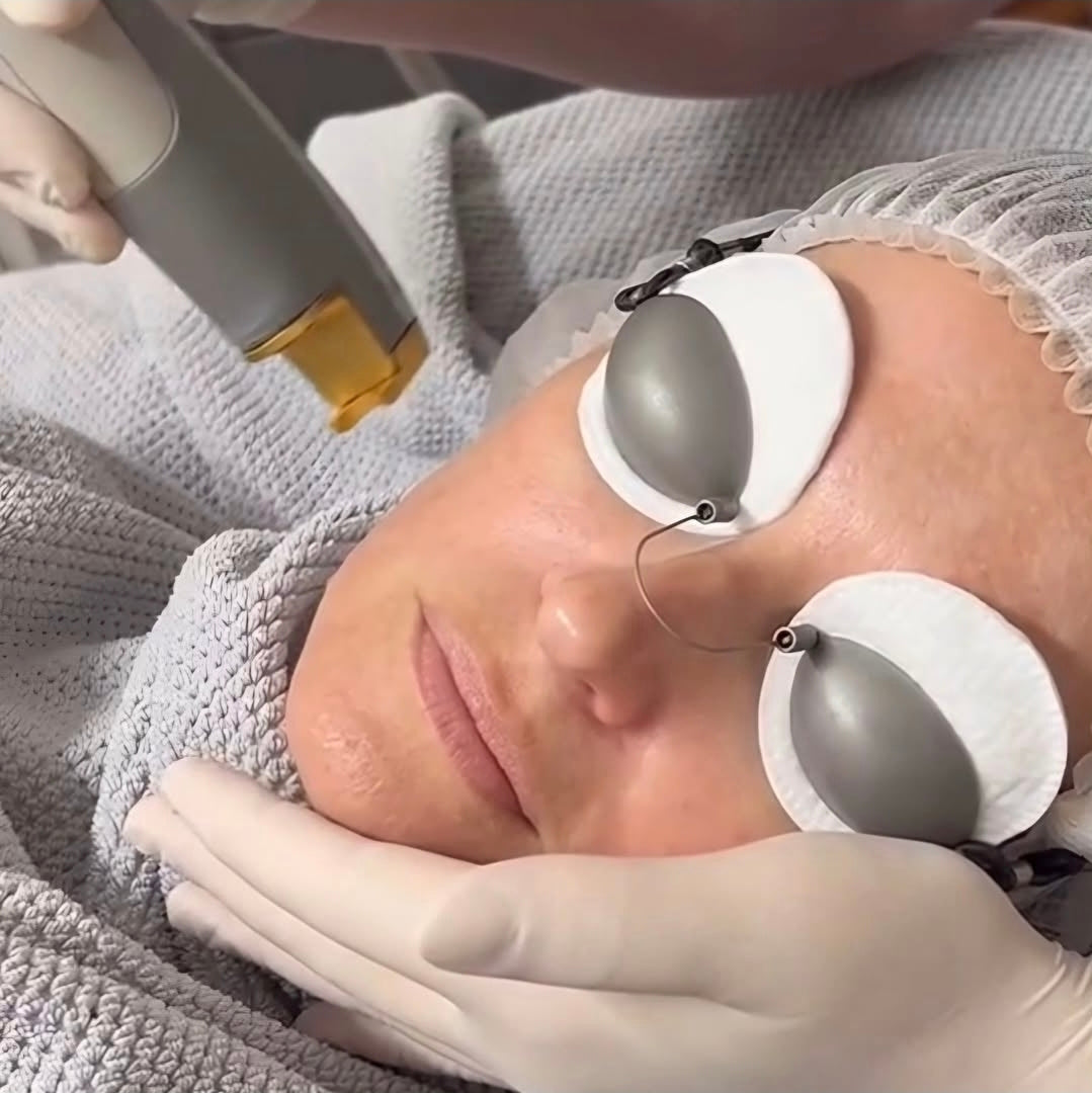 Laser Genesis Skin Rejuvenation Full Face *Promotion*